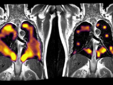 Los investigadores utilizaron gas xenón para detectar posibles daños en los pulmones de los pacientes que experimentan periodos de disnea después de haber tenido el virus