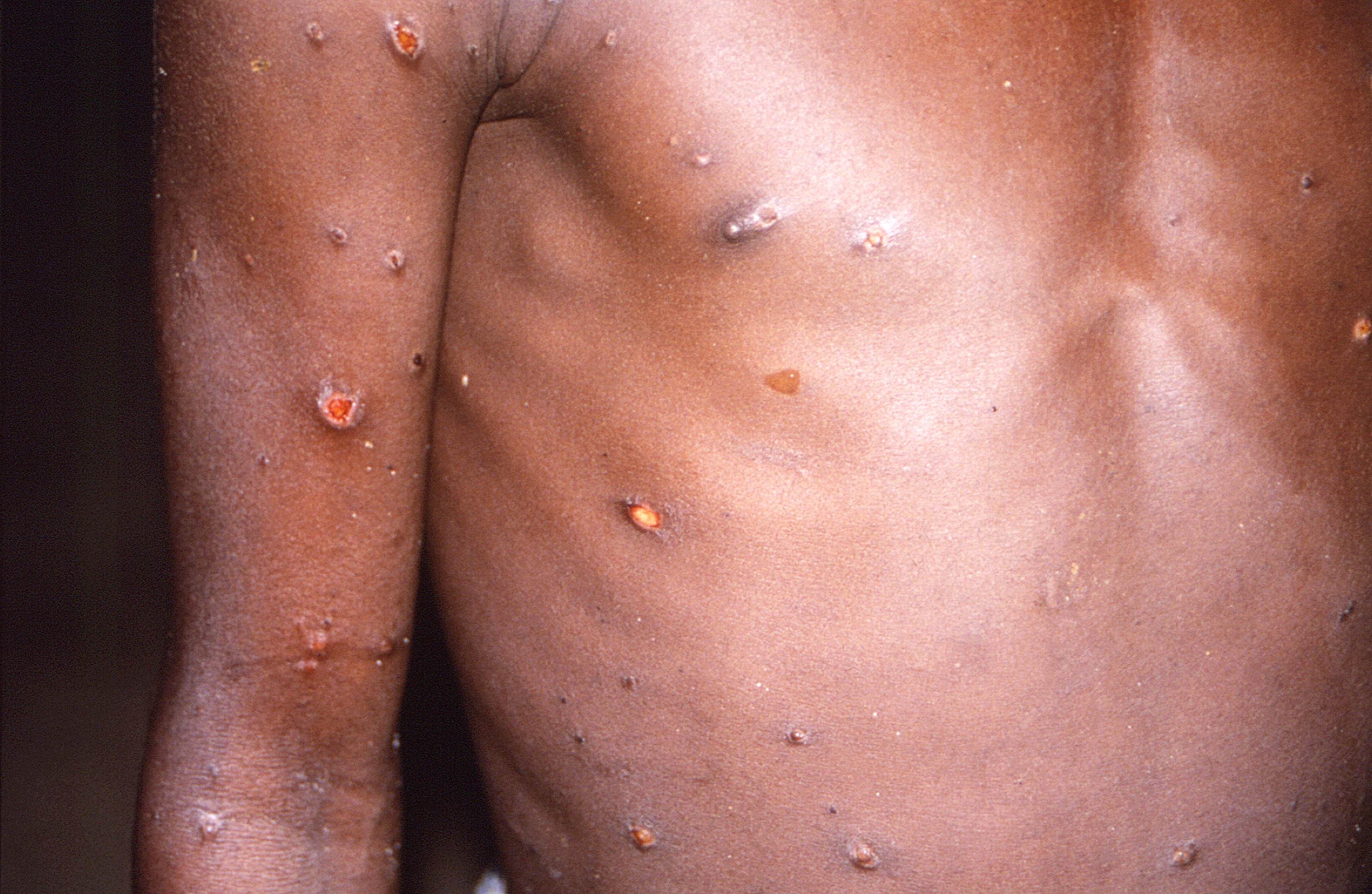 A la viruela del mono, una enfermedad que rara vez se manifiesta fuera de África, la han identificado autoridades de salud estadounidenses y europeas en los días recientes